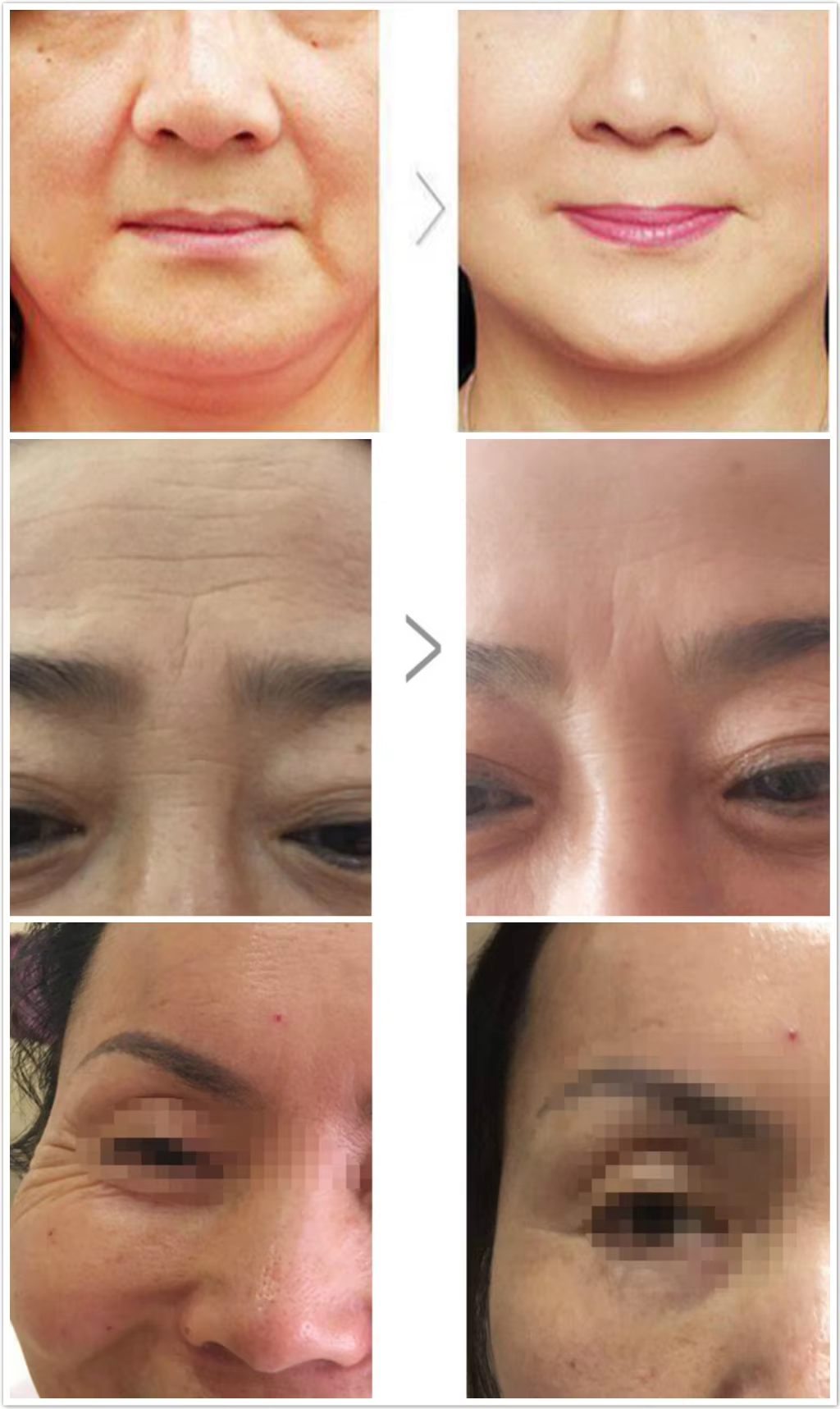  No Needle Mesotherapy Injection Gun 9