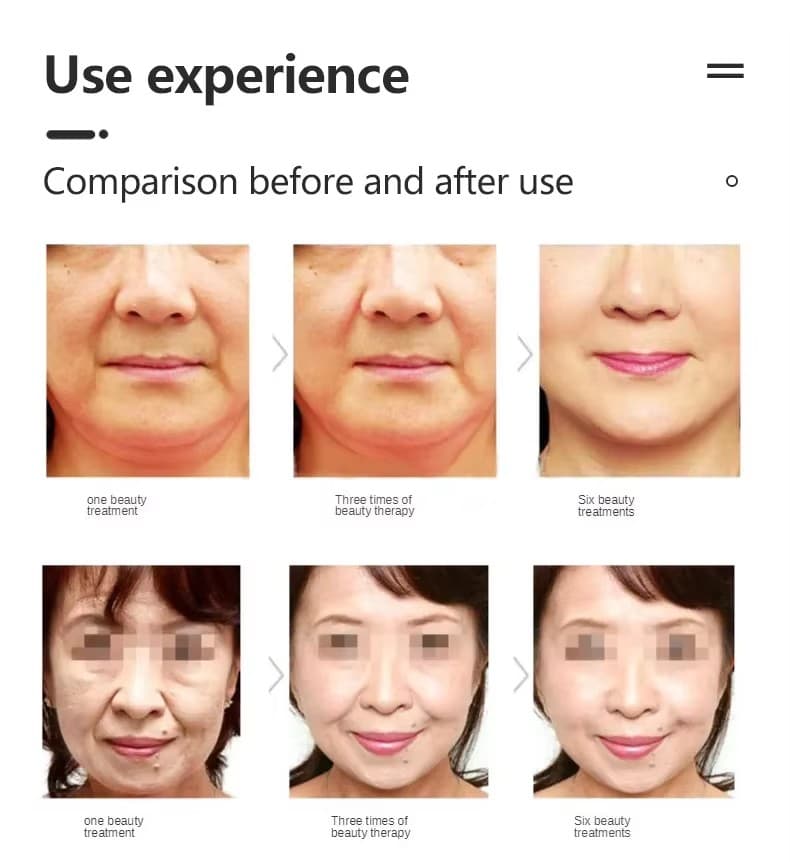 Vmax Facial Lifting 8